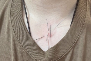 工作室晒赵继伟头&amp;喉咙针灸图片：嗓子治疗进入下一阶段 加油